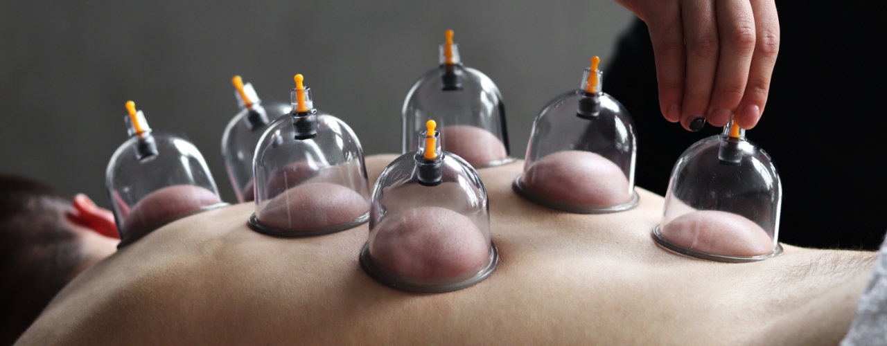 cupping-Boost-physical-therapy-and-sports-performance-belton-east-grain-valley-independence-lees-summit-warrensburg-mo-overland-park-ks